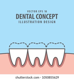 Square banner attrition (Bruxism) teeth illustration vector on blue background. Dental concept.