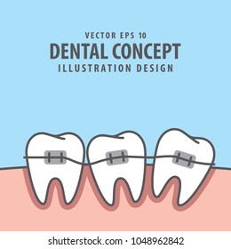 Square banner braces teeth  illustration vector on blue background. Dental concept.