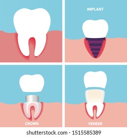 Square Banner Set Visualization of Different Ways Orthodontic Restoration as Implant, Crown, Dental Veneer. Teeth Problems Treatment Service. Stomatology Clinic Aid Cartoon Flat Vector Illustration,