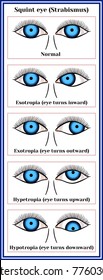 Squint eye (Strabismus). Deflection of visual axes.