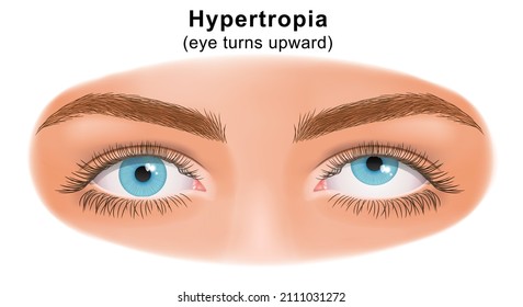 Squint eye (Strabismus). Hypertropia, eye turns upward. Deflection of visual axes. Vector illustration.