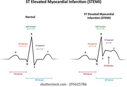 ST Elevated Myocardial Infarction STEMI