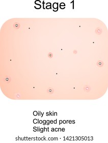 Stage 1 of development of acne. Inflamed skin with scars, acne and pimples. The texture of inflamed skin, and acne and pimples. Infographics. Vector illustration.