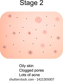 Stage 2 of development of acne. Inflamed skin with scars, acne and pimples. The texture of inflamed skin, and acne and pimples. Infographics. Vector illustration.