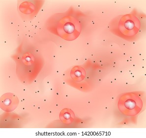 Stage 3 of development of acne. Inflamed skin with scars, acne and pimples. The texture of inflamed skin, and acne and pimples. Infographics. Vector illustration.