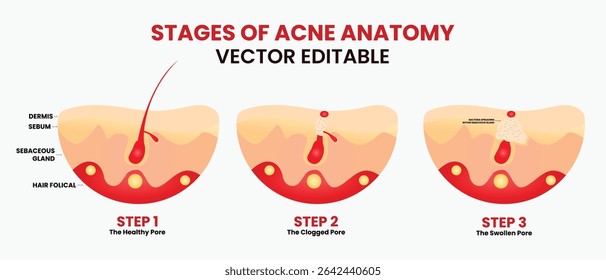 Estágio de Acne Anatomia, espinhas, poros da pele, cabeça negra, cabeça branca, cicatriz, comedão. Ícones vetoriais de espinhas de acne da pele, cosmetologia e problemas de cuidados da pele.