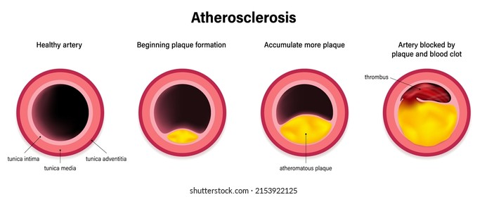 Stage Of Atherosclerosis Vector. Coronary Artery Syndrome. Coronary Heart Disease. Causes Of Myocardial Ischemia.