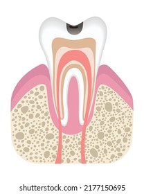 Stage of caries development. Tooth structure in flat style. Tooth decay with enamel. Dental disease realistic vector illustration