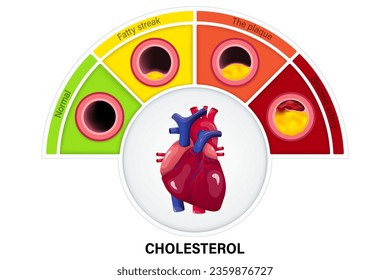 Etapa del colesterol en la arteria. Vector de aterosclerosis. Enfermedad de la arteria coronaria. Enfermedad coronaria cardíaca. Causas de isquemia miocárdica.