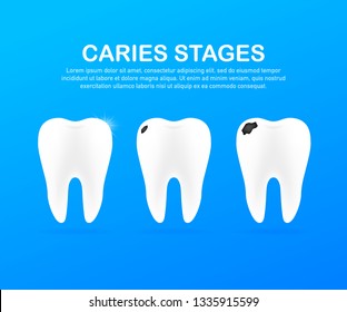 Stage of development of caries. Dental care concept. Healthy Teeth. Vector stock illustration.