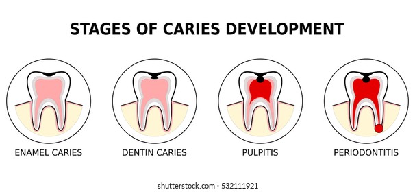 Stage of development of caries, vector illustration (enamel caries,dentin caries,pulpitis,periodontitis)