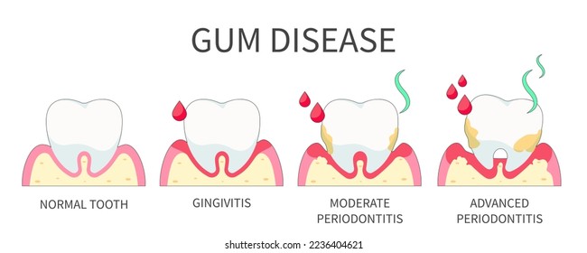 Stage of development of dental periodontitis, cartoon medical poster. Gum disease, dental concept. Vector concept dental health.