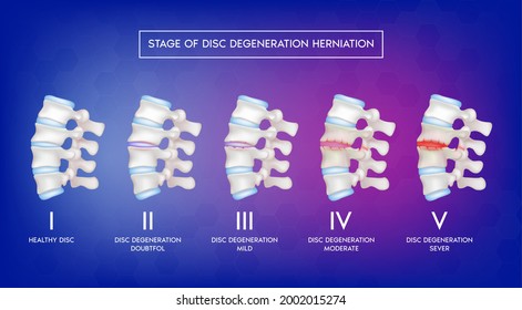 Stage of disc degeneration herniation. Spine disease, normal backbone, degenerative disc and herniated disc. Skeleton x ray scan concept. Human vertebrae anatomy medical. 3D Vector illustration