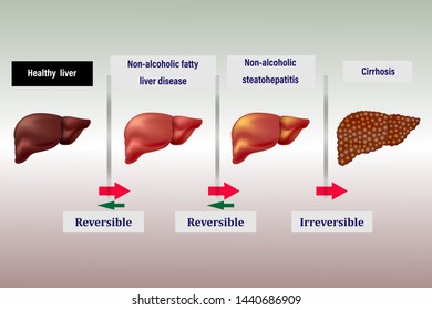 Liver Disease Healthy Internal Organ Fatty Stock Vector (Royalty Free ...