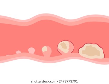 Stadium des Wachstumspolyps in einem malignen Tumor innerhalb der Organwand. Risiko von Krebs im menschlichen Verdauungssystem. Darmkrebszellen. flache Vektorillustration