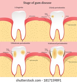 Stage of gum disease. Vector illustration