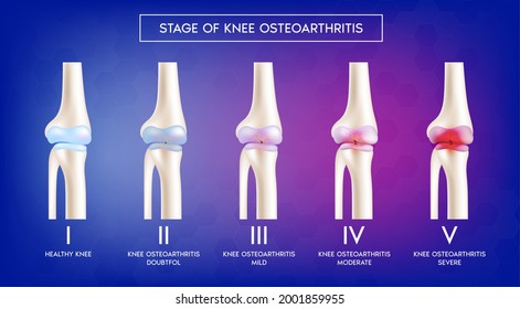 Stage Of Knee Osteoarthritis, Healthy Knee, Normal Bones. Skeleton X Ray Scan Concept. Human Vertebrae Anatomy Medical Flat. 3D Vector Illustration