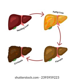 stage of liver damage fatty liver fibrosis cirrhosis medical healthcare disease health hospital