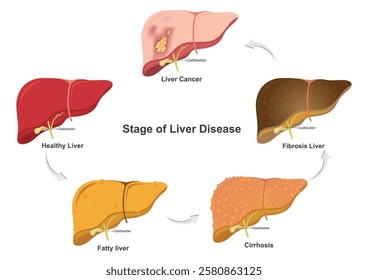 Stage of liver damage.These stages are fatty liver, hepatitis, fibrosis and cirrhosis.Liver disease can cause longstanding inflammation in the liver and accumulate mutations that can lead to cancer.