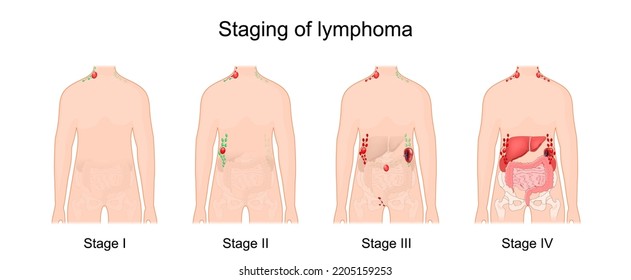 stage of a lymphoma. Cancer of the lymphatic system. Signs and symptoms disease. Human silhouette with normal and enlarged lymph nodes, and other affected internal organs. vector poster