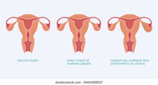 Stage of ovarian cancer, healthy ovaries,early stage of ovarian cancer and ovaries with cancer. Ovarian cancer refers to any cancerous growth that begins in the ovaries, vector illustration. 