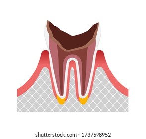 The stage of tooth decay / Dead tooth