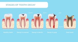 Stage Tooth Decay Infographic Medical Educational Scheme Names Diagnosis Vector Flat Illustration. Teeth Formation Steps, From Healthy To Deal, Forming Dental Plaque Caries In Enamel, Dentin And Pulp