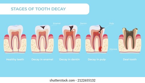 Stage tooth decay infographic medical educational scheme names diagnosis vector flat illustration. Teeth formation steps, from healthy to deal, forming dental plaque caries in enamel, dentin and pulp