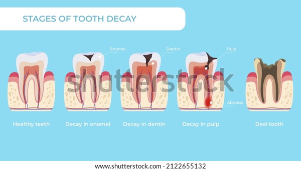 Stage tooth decay infographic medical educational\
scheme names diagnosis vector flat illustration. Teeth formation\
steps, from healthy to deal, forming dental plaque caries in\
enamel, dentin and pulp