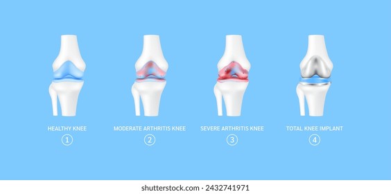 Stage of total knee replacement or implant. Healthy leg bone cartilage, moderate severe arthritis knee. Treatment relieve after joint damaged. Medical health care science technology concept. Vector.