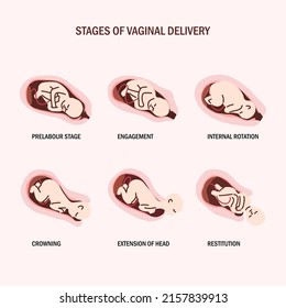 Stage of vaginal delivery flat illustration