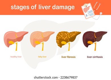 Ilustración vectorial en etapa del daño hepático de hígado sano a hígado graso.Fibrosis hepática a cirrosis diseño plano concepto sano