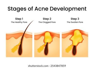 Estágios do Desenvolvimento da Acne