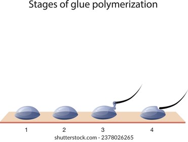 Stufen der Klebstoffpolymerisation in der Wimpernverlängerung. 