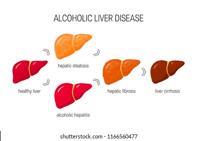 2,780 Liver failure Images, Stock Photos & Vectors | Shutterstock