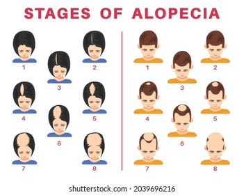 Stages of alopecia in men and women vector illustrations set. Tops of male and female heads with bald spots on scalps isolated on white background. Health, hair loss or treatment concept