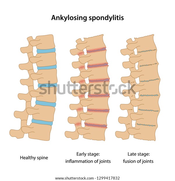 強直性脊椎炎の段階 正常な円盤 関節の炎症 関節の融合 白い背景にベクターイラスト のベクター画像素材 ロイヤリティフリー