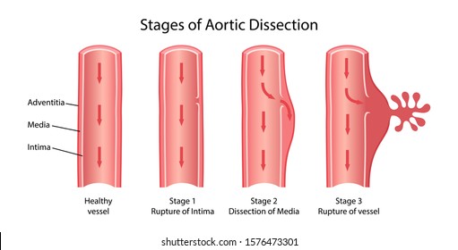 Stages of aortic dissection: rupture Intima, dissection Media, rupture vessel. Image of healthy and damaged aorta. Vector illustration in flat style with main description isolated on white background