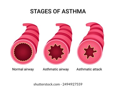 Stages of an asthma attack