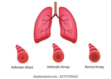 Stages of an asthma attack. medical illustration. vector eps 10