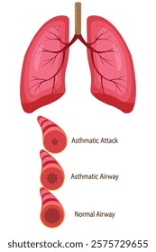 Stages of an asthma attack. medical illustration. vector eps 10