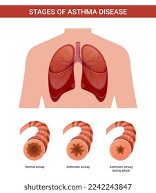 Etapas de la ilustración del vector del asma
