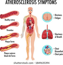 Stages of atherosclerosis information infographic illustration