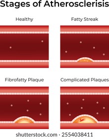 Stages of Atherosclerosis Science Design Vector Illustration Diagram