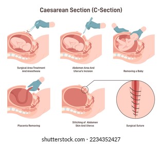 Stages of baby birth with caesarean section. Fetus position during the labor. Biology and gynecology. Flat vector illustration