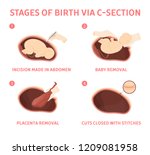 Stages of baby birth via cesarean section . Fetus movement during the c-section. Biology and gynecology. Isolated vector illustration