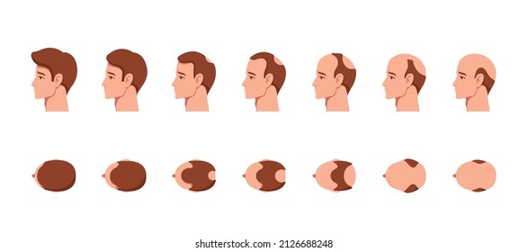 Stages of Baldness of Men. Male Characters Head Top and Side View with Hair Grow or Loss Process, Health and Aging Problems, Transplantation Infographics Elements. Cartoon People Vector Illustration