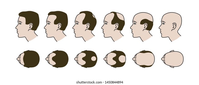 Stages of baldness, transplantation and hair extensions, treatment of baldness