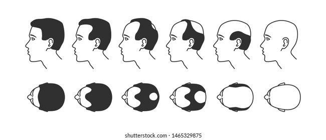 Stages of baldness, transplantation and hair extensions, treatment of baldness