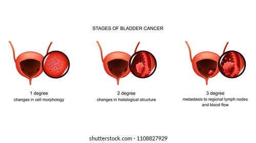 Stages Of Bladder Cancer